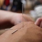 acupuncture, needles, hand, medicine, physiotherapy, therapy, traditional, wellness, skin, spa, closeup, acupuncture, acupuncture, acupuncture, acupuncture, acupuncture